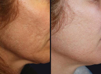 Microneedling Before & After Gallery - Patient 177905332 - Image 1