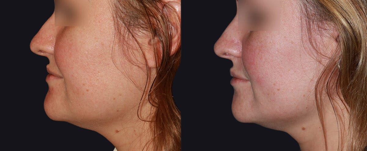 Non Surgical Rhinoplasty Before & After Gallery - Patient 177905331 - Image 2