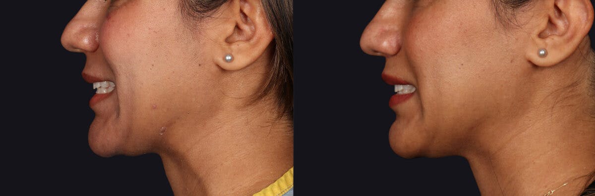 Lip Lift Before & After Gallery - Patient 582791 - Image 9
