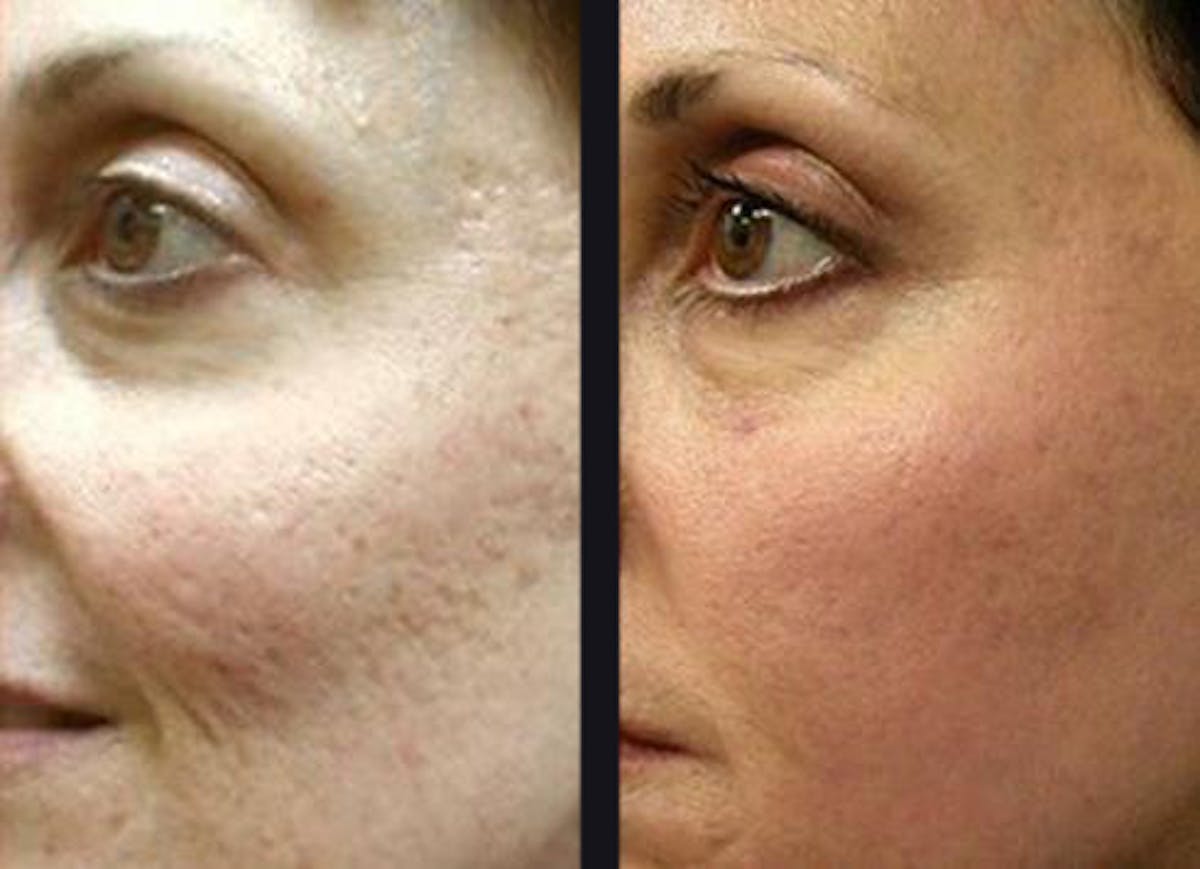 Microneedling Before & After Gallery - Patient 177905329 - Image 1