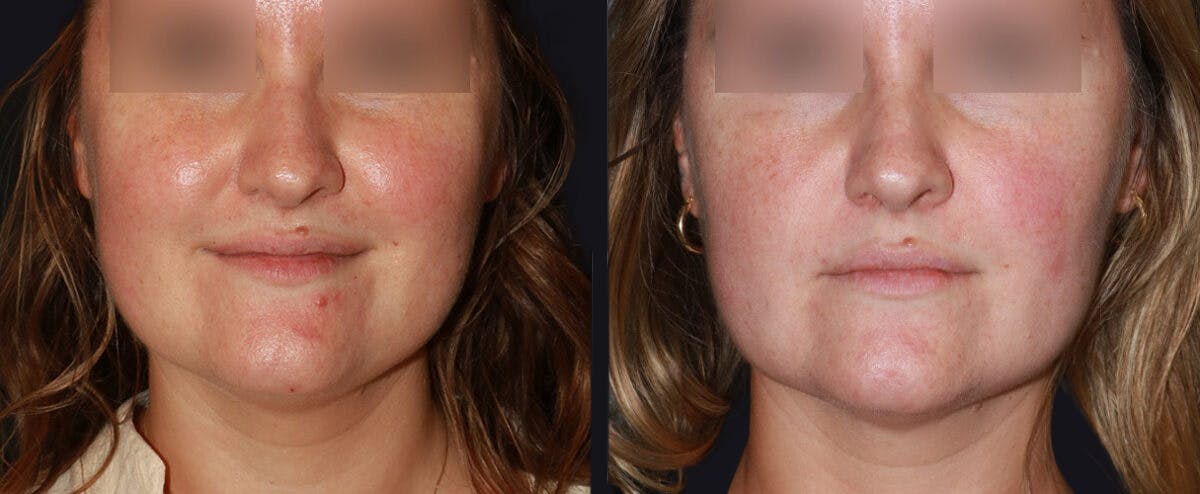 Non Surgical Rhinoplasty Before & After Gallery - Patient 177905331 - Image 1