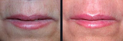Microneedling Before & After Gallery - Patient 177905328 - Image 1