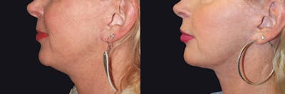 MyEllevate Neck Lift Before & After Gallery - Patient 177905327 - Image 1