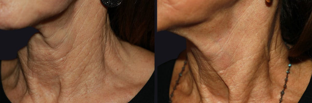 Microneedling Before & After Gallery - Patient 177905325 - Image 2