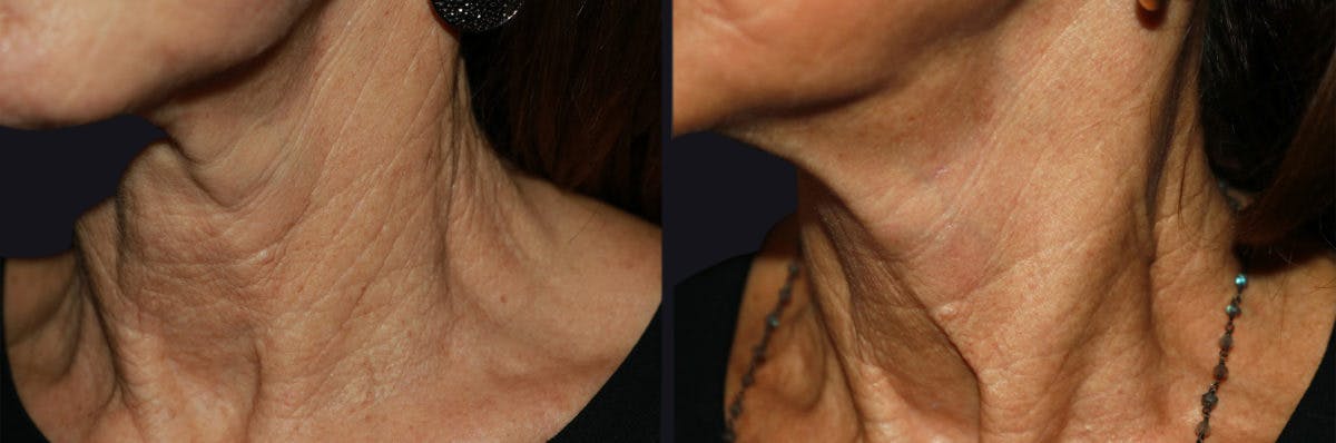 Microneedling Before & After Gallery - Patient 177905325 - Image 2