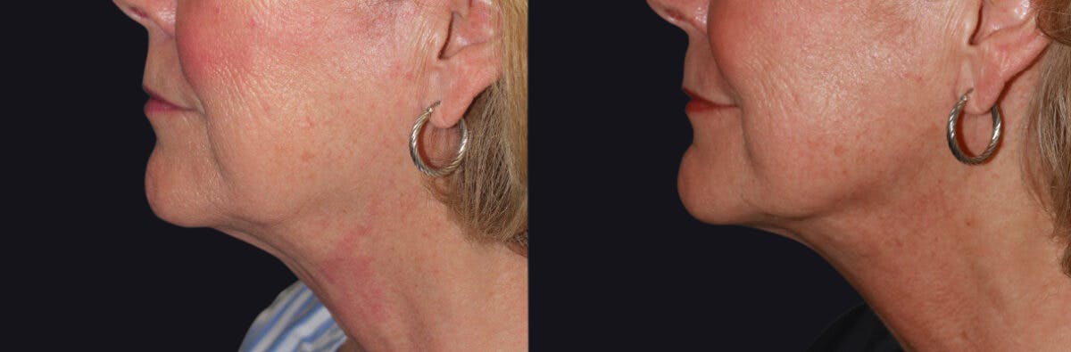 MyEllevate Neck Lift Before & After Gallery - Patient 177905324 - Image 2