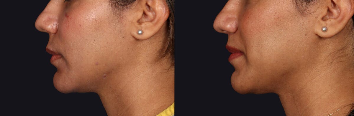 Lip Lift Before & After Gallery - Patient 582791 - Image 5