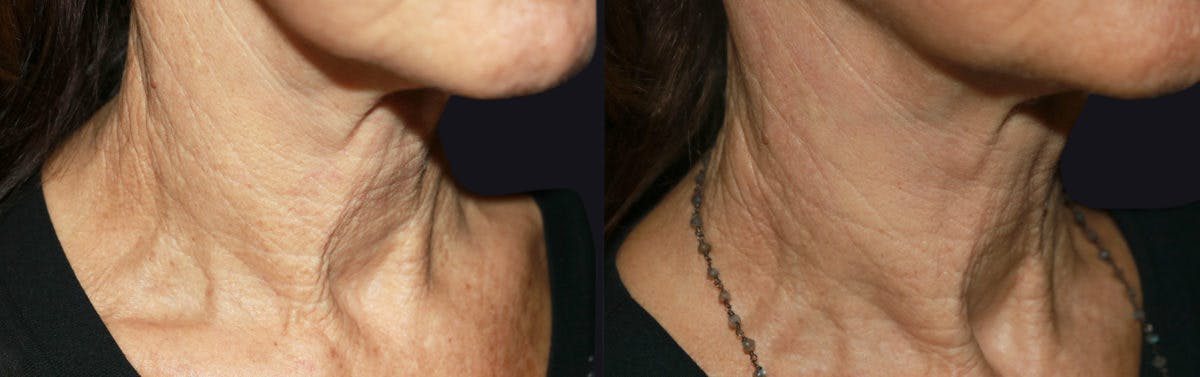 Microneedling Before & After Gallery - Patient 177905325 - Image 1