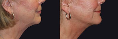 MyEllevate Neck Lift Before & After Gallery - Patient 177905324 - Image 1