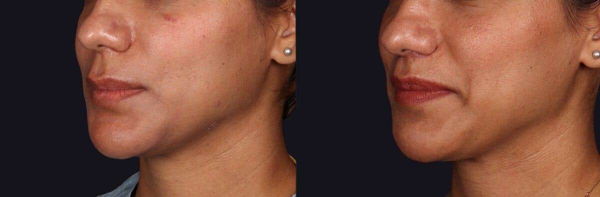 Lip Lift Before & After Gallery - Patient 582791 - Image 4