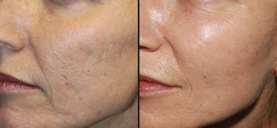 Microneedling Before & After Gallery - Patient 177905320 - Image 1