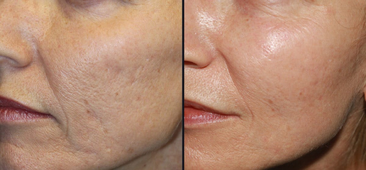 Microneedling Before & After Gallery - Patient 177905320 - Image 1