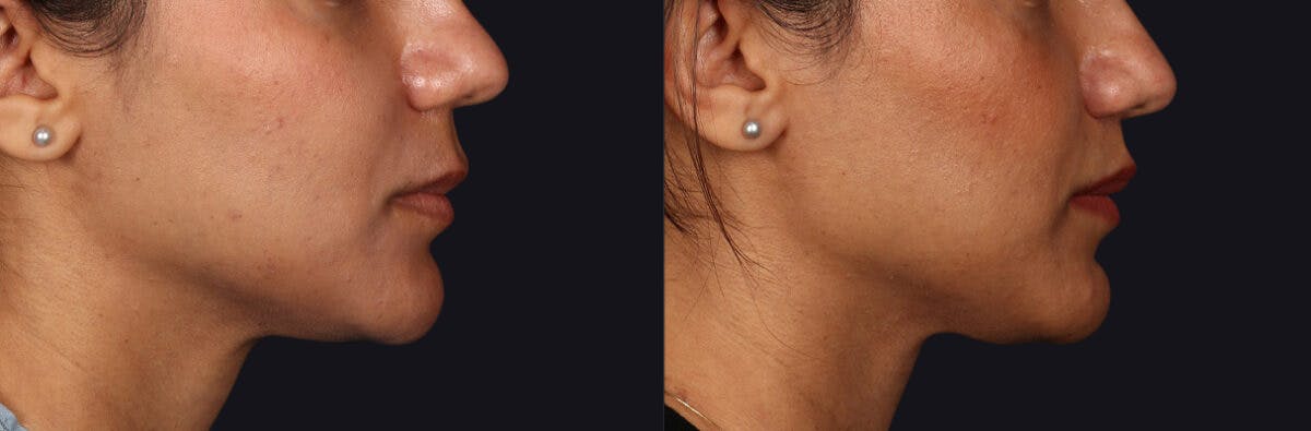 Lip Lift Before & After Gallery - Patient 582791 - Image 4