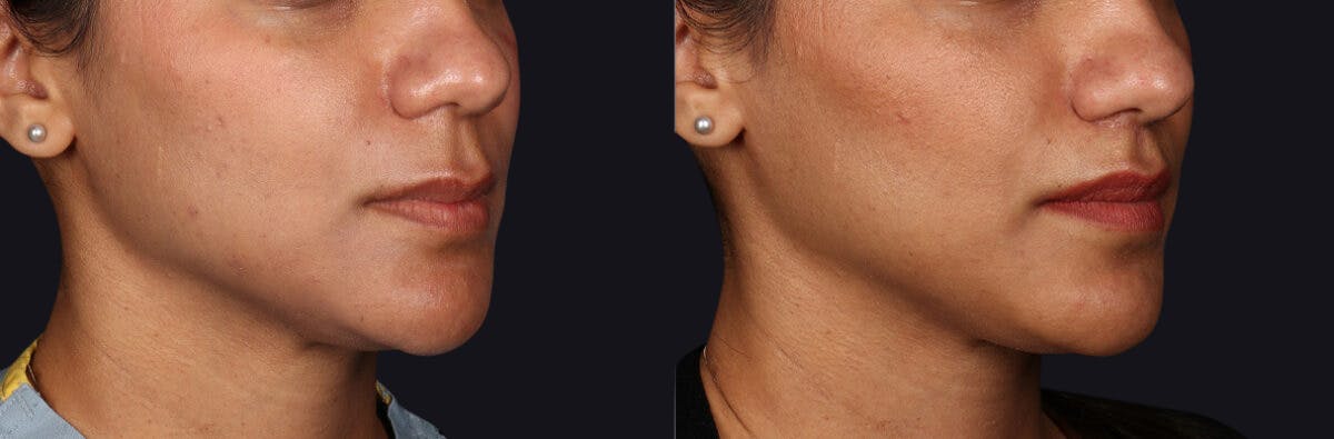 Lip Lift Before & After Gallery - Patient 582791 - Image 2