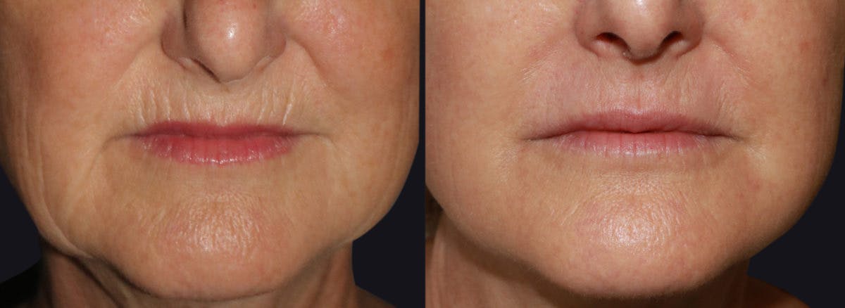 Microneedling Before & After Gallery - Patient 167363 - Image 1