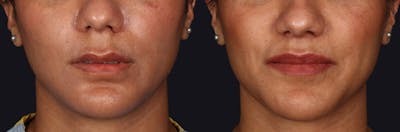 Lip Lift Before & After Gallery - Patient 582791 - Image 1
