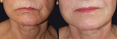 Lip Augmentation Before & After Gallery - Patient 177905293 - Image 1