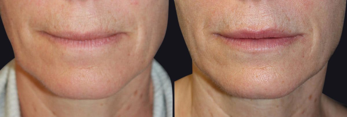 Lip Augmentation Before & After Gallery - Patient 177905292 - Image 1