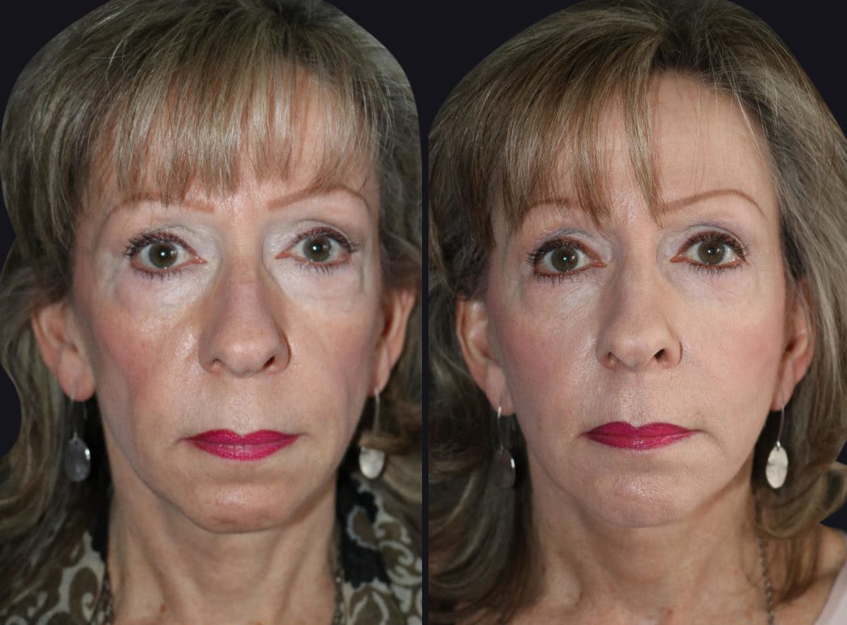 Fat Injections Before & After Gallery - Patient 177905291 - Image 1