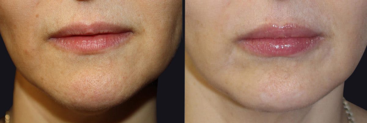 Lip Augmentation Before & After Gallery - Patient 177905290 - Image 1