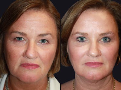 Dermal Fillers Before & After Gallery - Patient 177905289 - Image 1