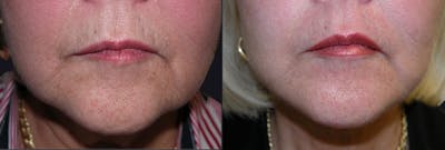 Lip Augmentation Before & After Gallery - Patient 177905287 - Image 1