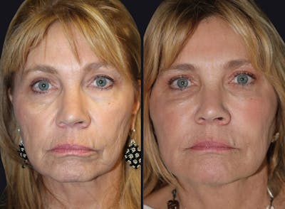 Dermal Fillers Before & After Gallery - Patient 177905286 - Image 1