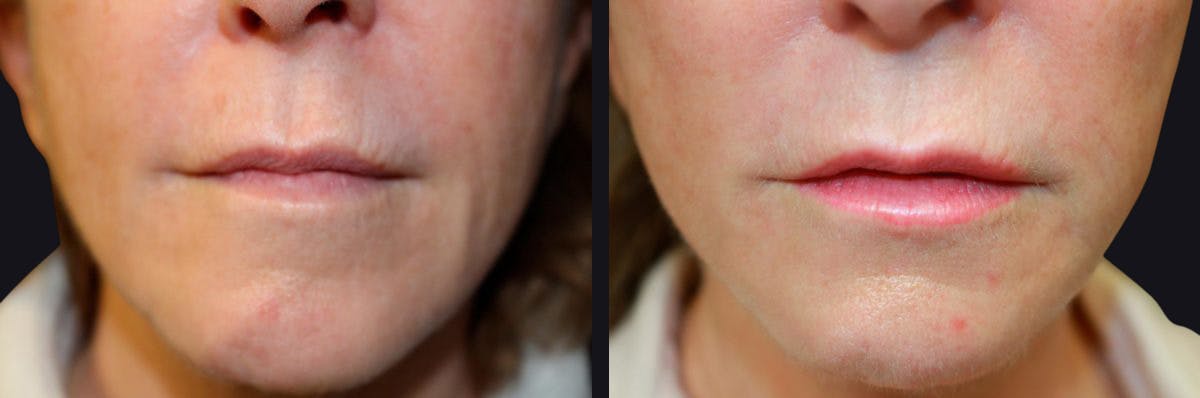 Lip Augmentation Before & After Gallery - Patient 177905284 - Image 1