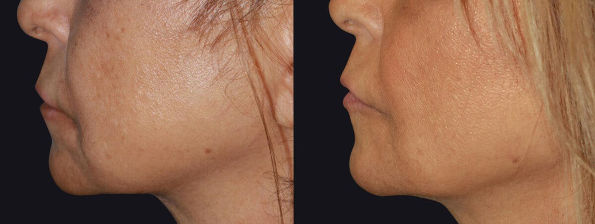 Dermal Fillers Before & After Gallery - Patient 177905283 - Image 2