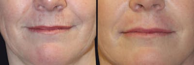 Lip Augmentation Before & After Gallery - Patient 177905281 - Image 1