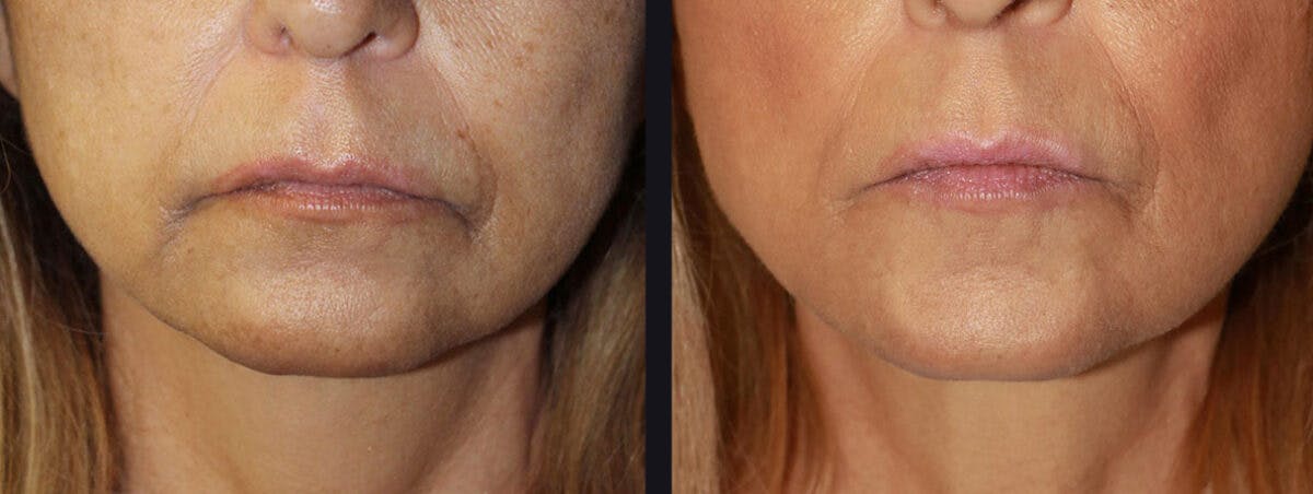 Dermal Fillers Before & After Gallery - Patient 177905283 - Image 1