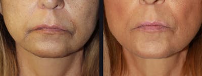 Dermal Fillers Before & After Gallery - Patient 177905283 - Image 1