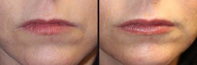 Lip Augmentation Before & After Gallery - Patient 177905276 - Image 1