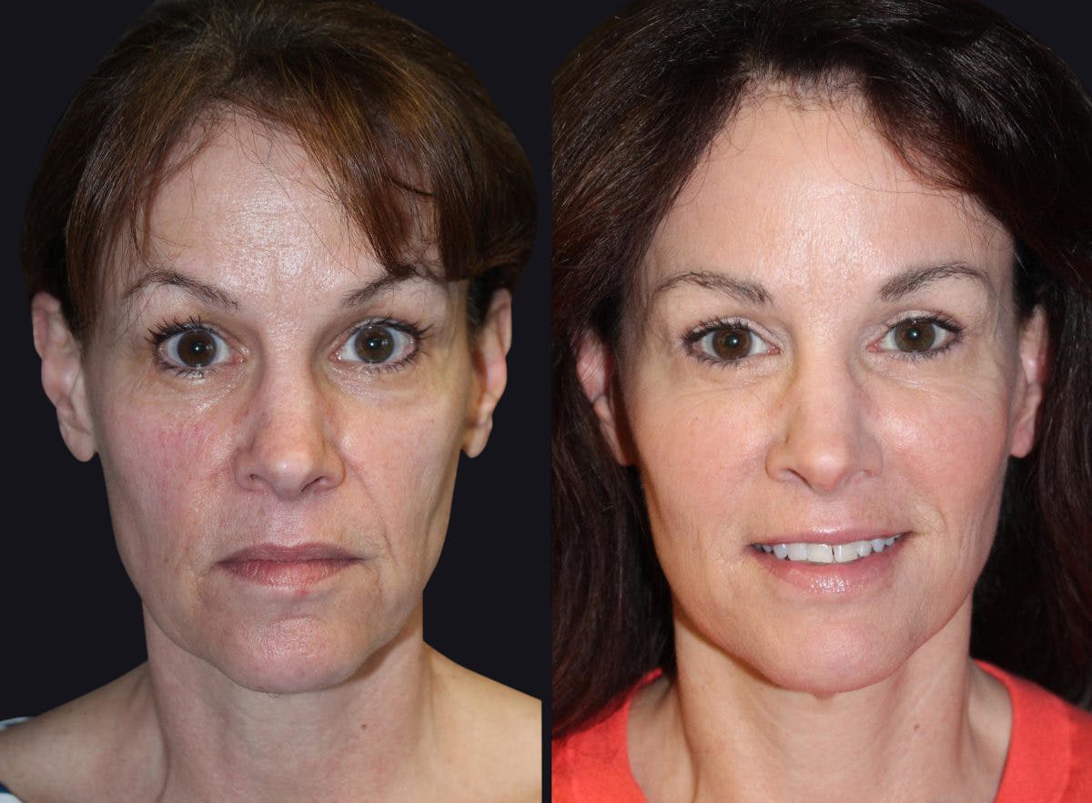 Dermal Fillers Before & After Gallery - Patient 177905275 - Image 1