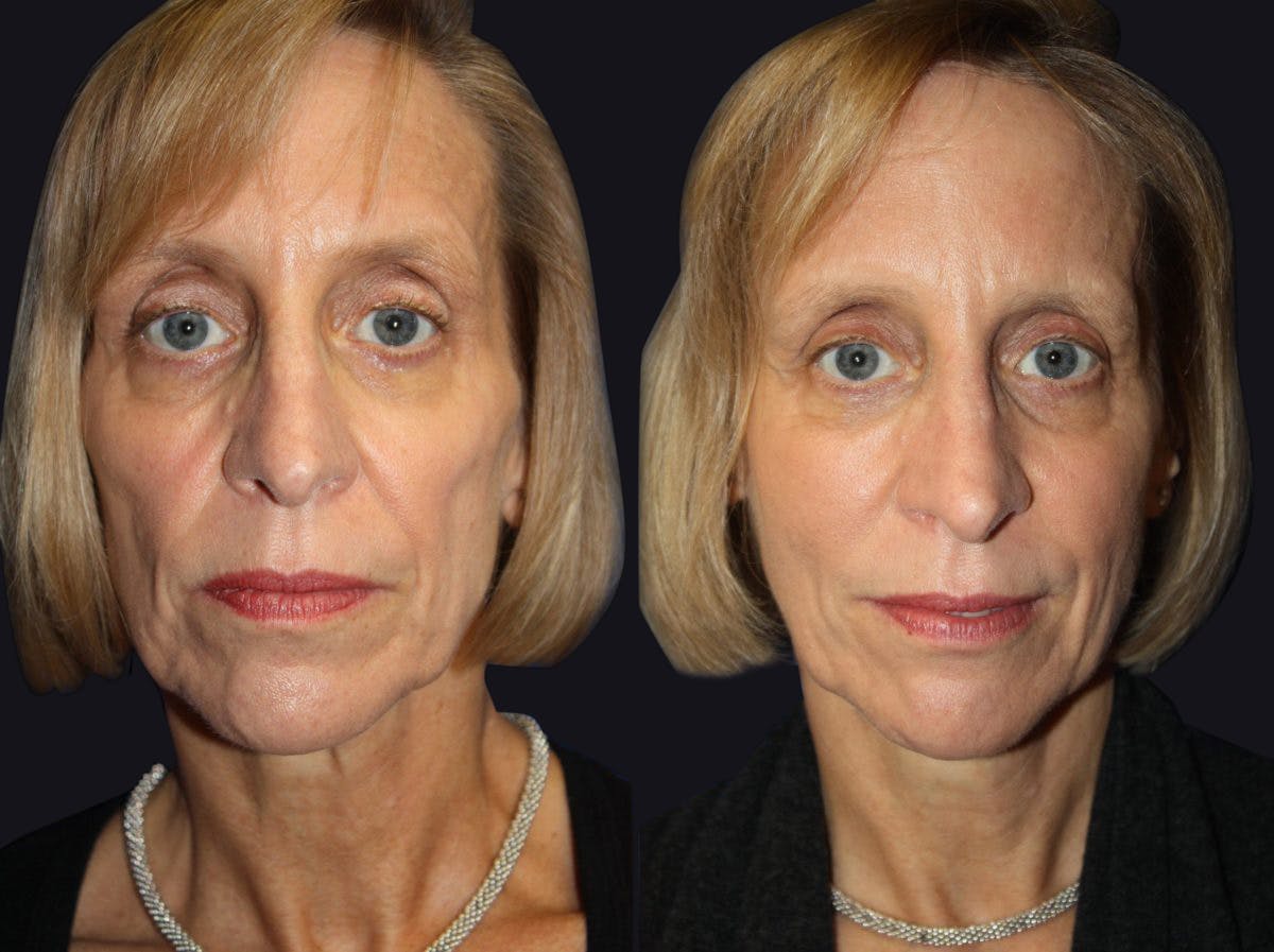 Fat Injections Before & After Gallery - Patient 177905274 - Image 1