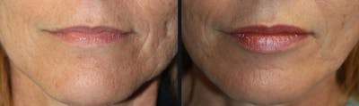 Lip Augmentation Before & After Gallery - Patient 177905273 - Image 1