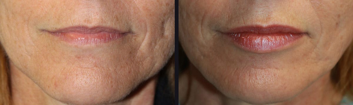 Lip Augmentation Before & After Gallery - Patient 177905273 - Image 1