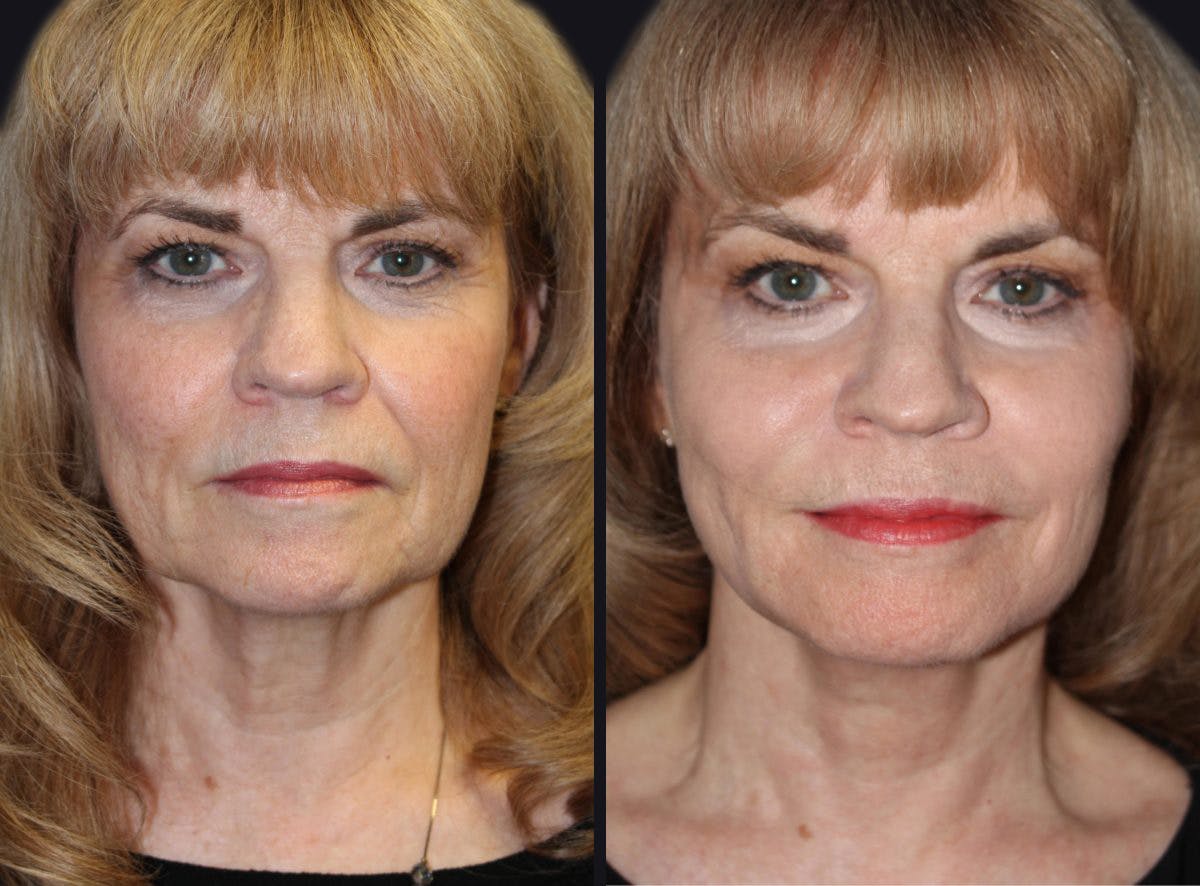 Dermal Fillers Before & After Gallery - Patient 177905272 - Image 1