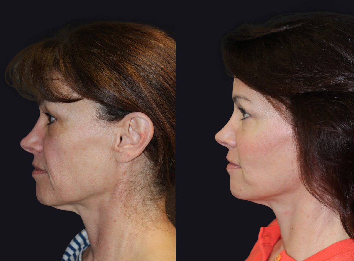 Fat Injections Before & After Gallery - Patient 177905271 - Image 2