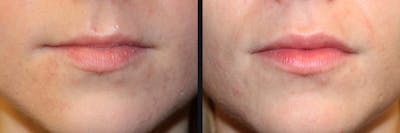 Lip Augmentation Before & After Gallery - Patient 177905264 - Image 1