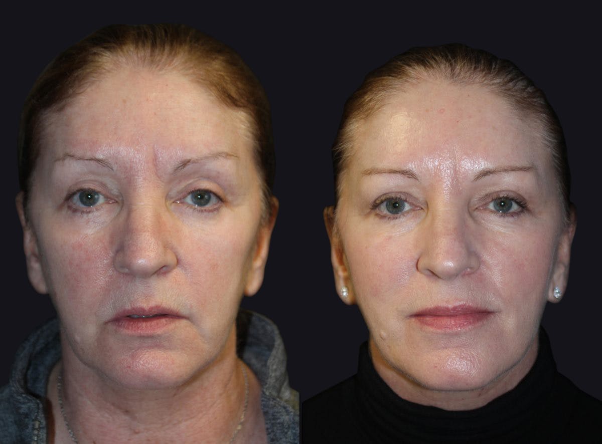 Dermal Fillers Before & After Gallery - Patient 177905263 - Image 1