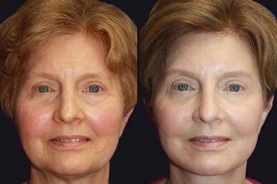 Dermal Fillers Before & After Gallery - Patient 177905260 - Image 1