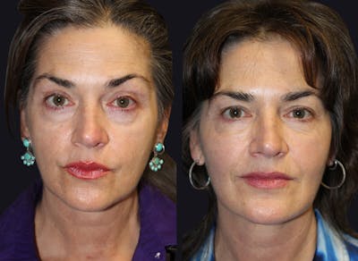 Dermal Fillers Before & After Gallery - Patient 177905259 - Image 1