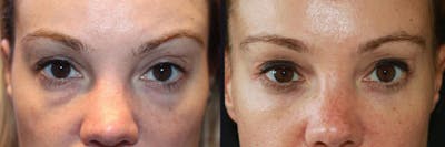 Dermal Fillers Before & After Gallery - Patient 177905256 - Image 1