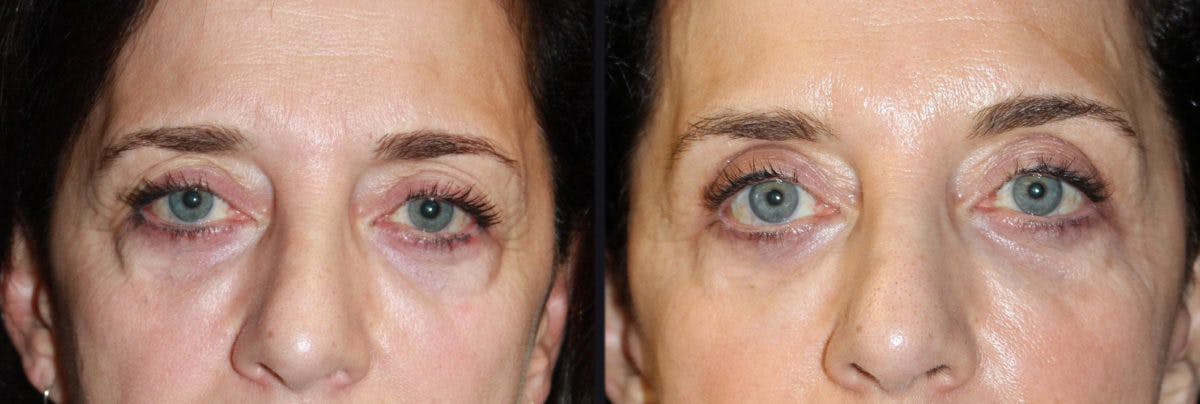 Botox Before & After Gallery - Patient 177904633 - Image 1