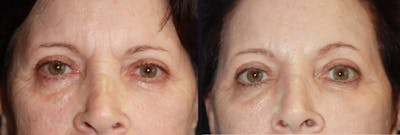 Botox Before & After Gallery - Patient 177904627 - Image 1