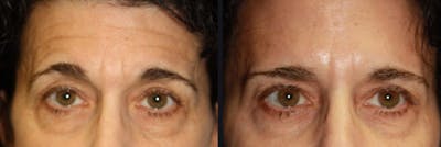 Botox Before & After Gallery - Patient 177904626 - Image 1