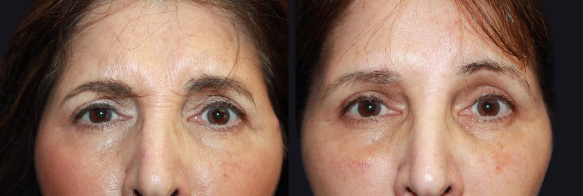 Botox Before & After Gallery - Patient 177904625 - Image 1