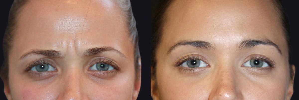 Botox Before & After Gallery - Patient 177904623 - Image 1