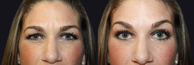 Botox Before & After Gallery - Patient 177904622 - Image 1